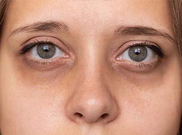 Under-Eye-Dark-Circles